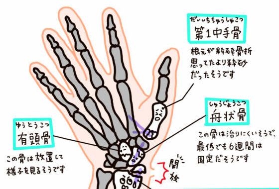 『今回の骨折のまとめ〜骨折は痛いよ！これからリハビリも頑張るよ〜の巻』